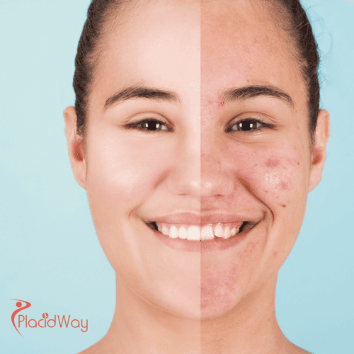 Acne Scar Treatment in South Korea: Advanced Skin Solutions for Australian Travelers